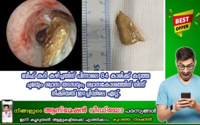 ബീഫ് കറി കഴിച്ചതിന് പിന്നാലെ 84 കാരിക്ക് കടുത്ത ചുമയും ശ്വാസ തടസവും; ശ്വാസകോശത്തിന് നിന്ന് നീക്കിയത് ഇറച്ചിയിലെ എല്ല്.